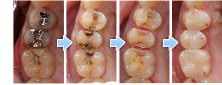 金属と樹脂の詰め物の下にできた虫歯を取り除き、セラミックの詰め物を入れた症例
