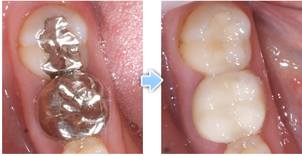 下の奥歯の金属の被せものと詰めものをセラミックにした症例