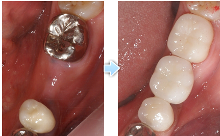 金属と樹脂の詰め物の下にできた虫歯を取り除き、セラミックの詰め物を入れた症例