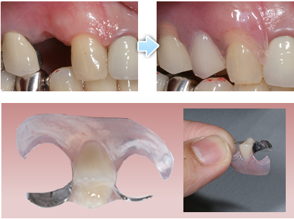 歯のないところに針金を使わない入れ歯を入れた症例