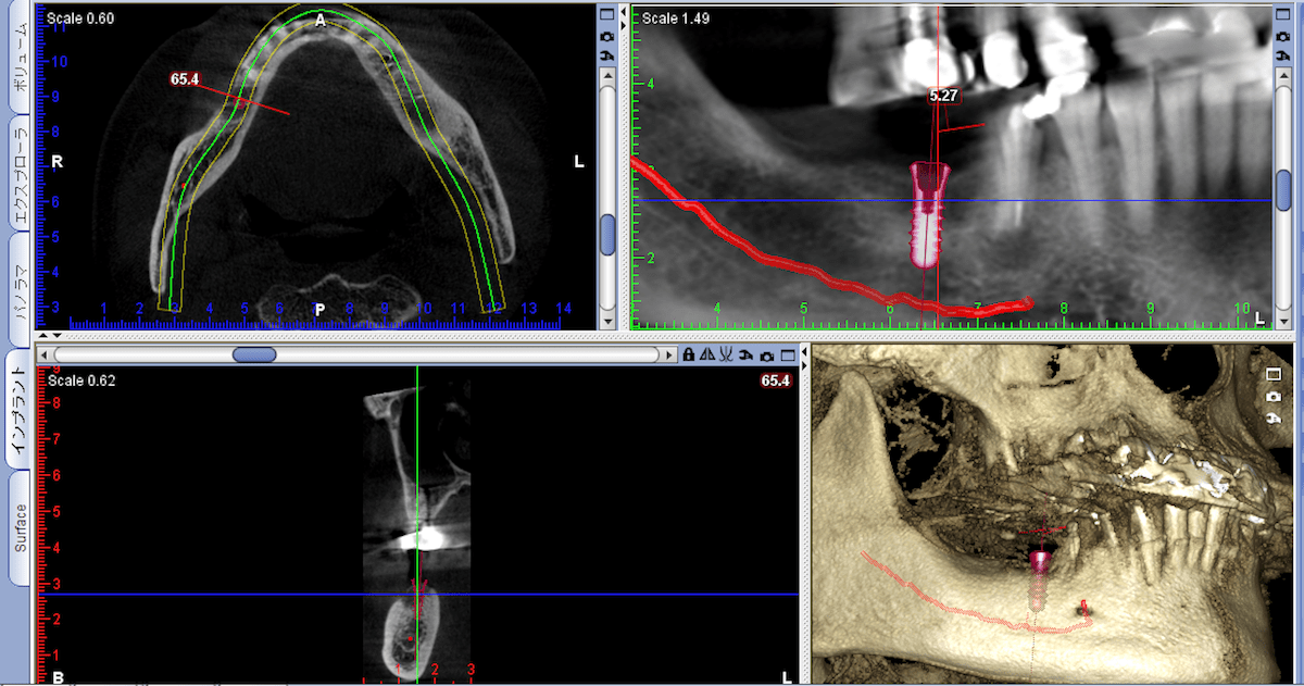 CTによる正確な3D画像診断